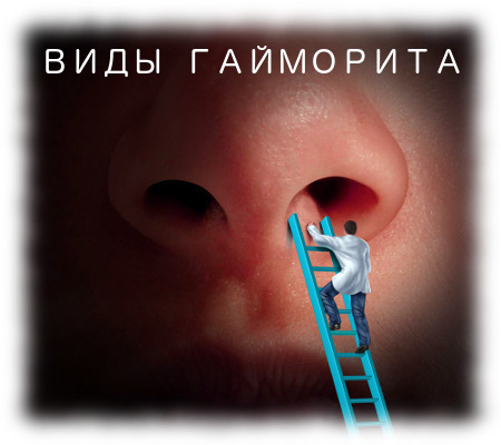 Ексудативний гайморит: лікування та форми хвороби