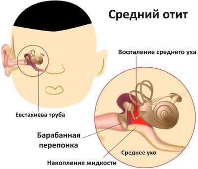 Кров з вуха при отиті – причини і лікування 2019 Кров з вуха при отиті – причини і лікування 2019
