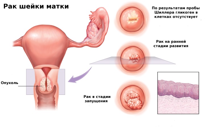 Лікування міоми матки лікарськими препаратами