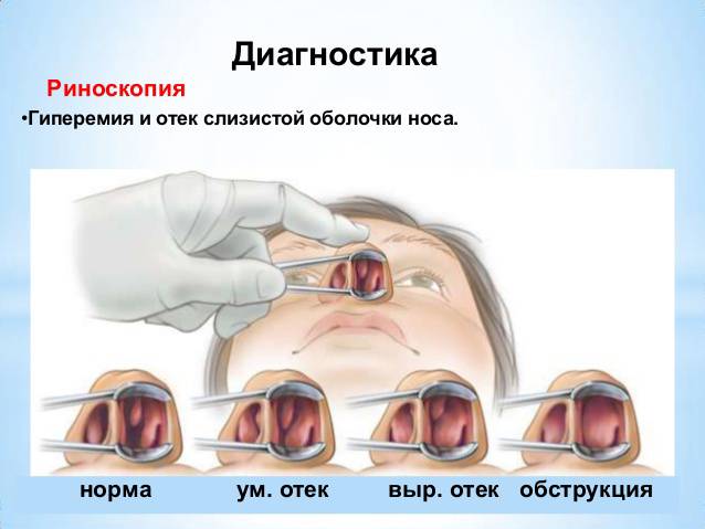 Лікування набряку слизової оболонки носа у дітей і дорослих