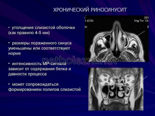 Риносинусит симптоми і лікування у дорослих