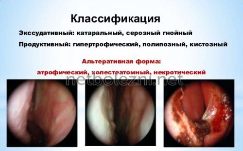 Риносинусит симптоми і лікування у дорослих