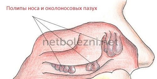 Риносинусит симптоми і лікування у дорослих