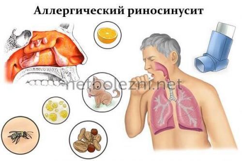 Риносинусит симптоми і лікування у дорослих
