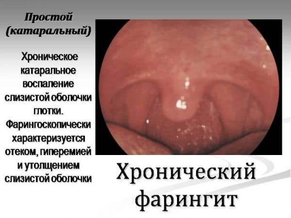 Як лікувати фарингіт у дітей в домашніх умовах народними засобами 2019