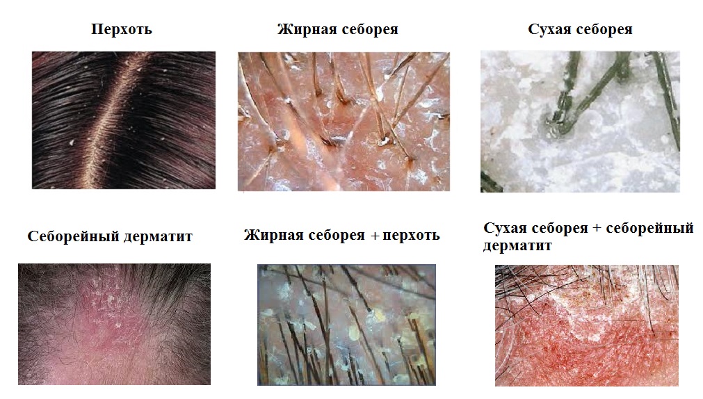 Лікування лупи: швидке і ефективне відновлення шкіри голови