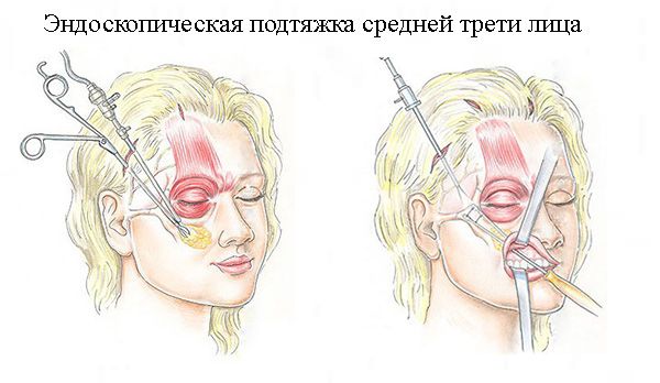 Операція підтяжки середньої третини обличчя з фото результату
