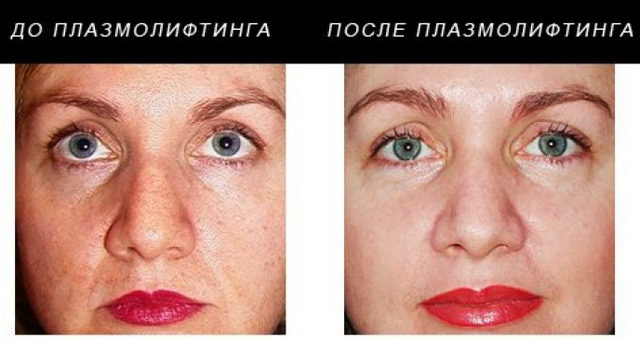 Переваги плазмолифтинга особи, ціна, фото до і після