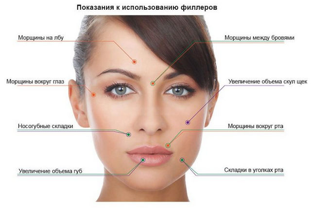 Показання і ефект від застосування Otesaly філера