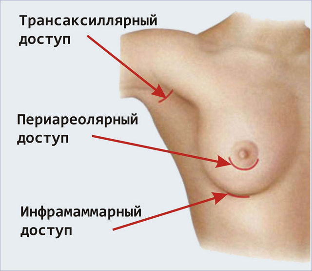 Види шрамів після підтяжки грудей і як їх уникнути
