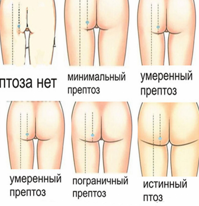 Всі способи підтяжки сідниць з фото до і після