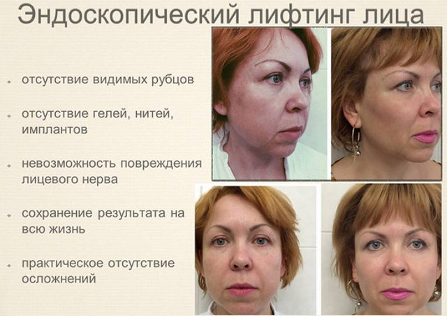 Як підтягнути лоб: методи і фото до і після