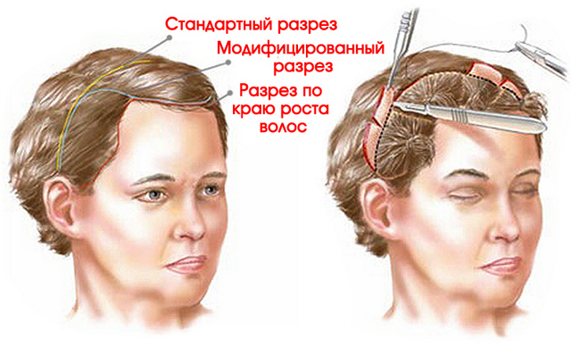 Як підтягнути лоб: методи і фото до і після