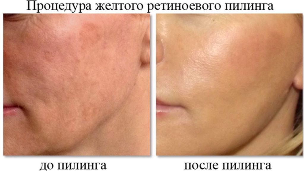 Жовтий пілінг (ретиноевый) — що це таке і як його роблять